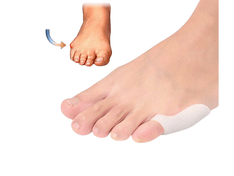 1 pair Bunionette Little Toe Corrector (White) - Glowish