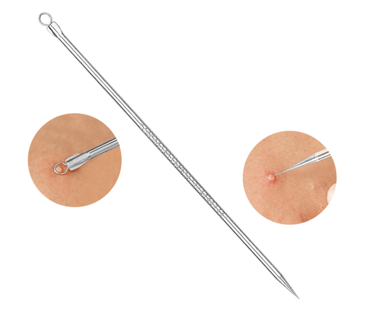 3Pcs Stainless steel Blackhead Acne Extractor - Glowish