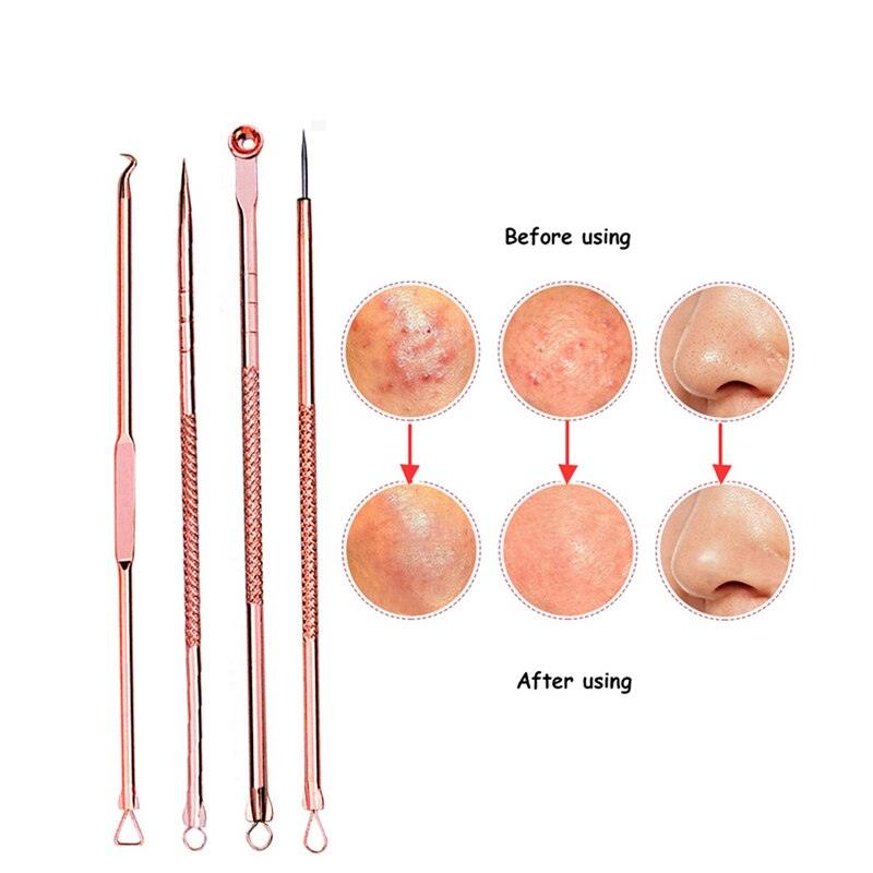 4PCS Acne Blackhead Pimple Black Spot Blemish Remover Tool - Glowish